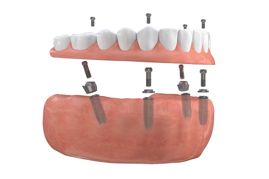 Are you missing all your teeth and would like to get beautiful smile quickly and permanently? Contact us to see if you are a candidate for full mouth restoration with dental implants near Evanston, IL. Full Mouth Restoration in Evanston, IL