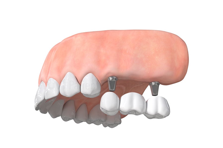 Are you missing multiple teeth? Contact Way Dental to see if you are a candidate for a dental implant bridge near Evanston, IL. Missing Multiple Teeth in Evanston, IL