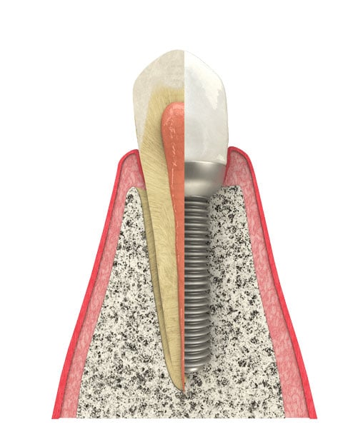 Schedule a dental consultation with Dr. Andre Amarante, well-qualified cosmetic dentist in Evanston IL, to restore your teeth with dental implants near 60202. Dental Implants in Evanston, IL