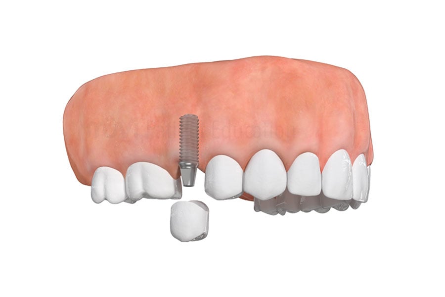 Dental Implant in Evanston, IL