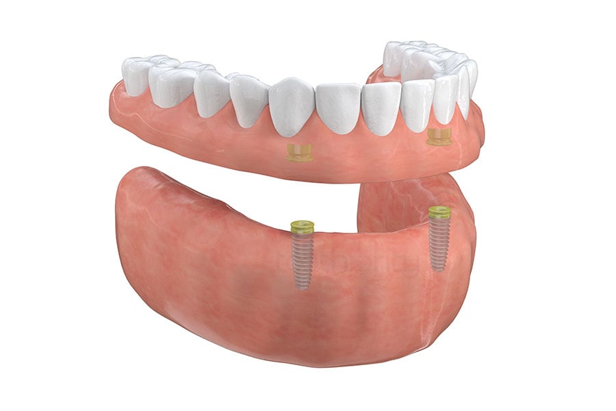 Let Dr. Andre Amarante, well-qualified cosmetic dentist near 60202, help you get a brighter smile than ever before with dental implants near Evanston, IL today! Implant-Supported Overdentures in Evanston, IL