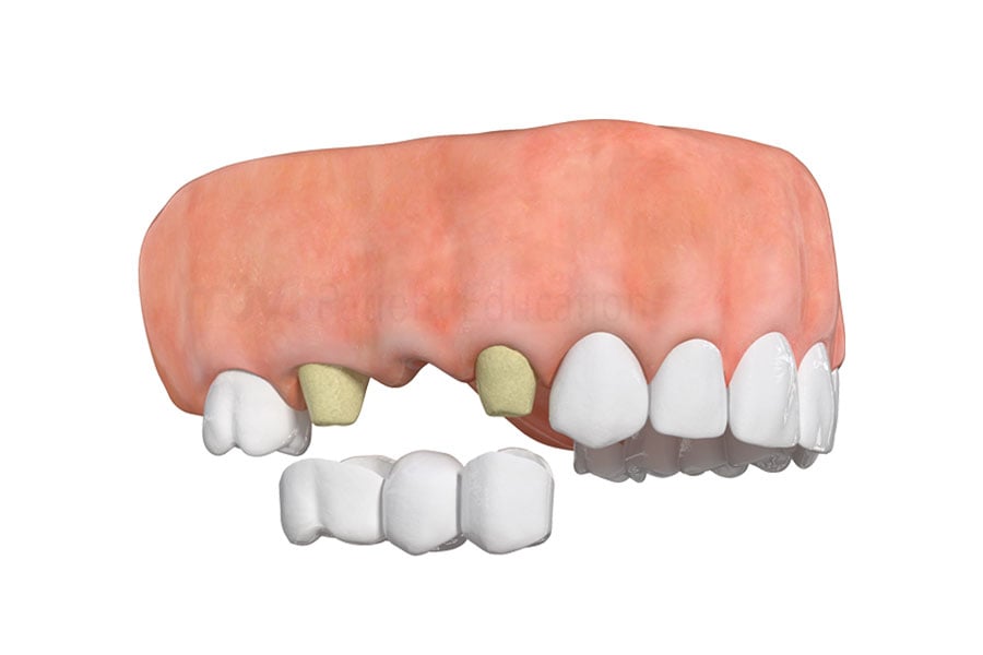 Schedule a dental consultation with Dr. Andre Amarante, well-qualified cosmetic dentist in Evanston IL, to restore your teeth with dental implants near 60202. Traditional Bridge in Evanston, IL