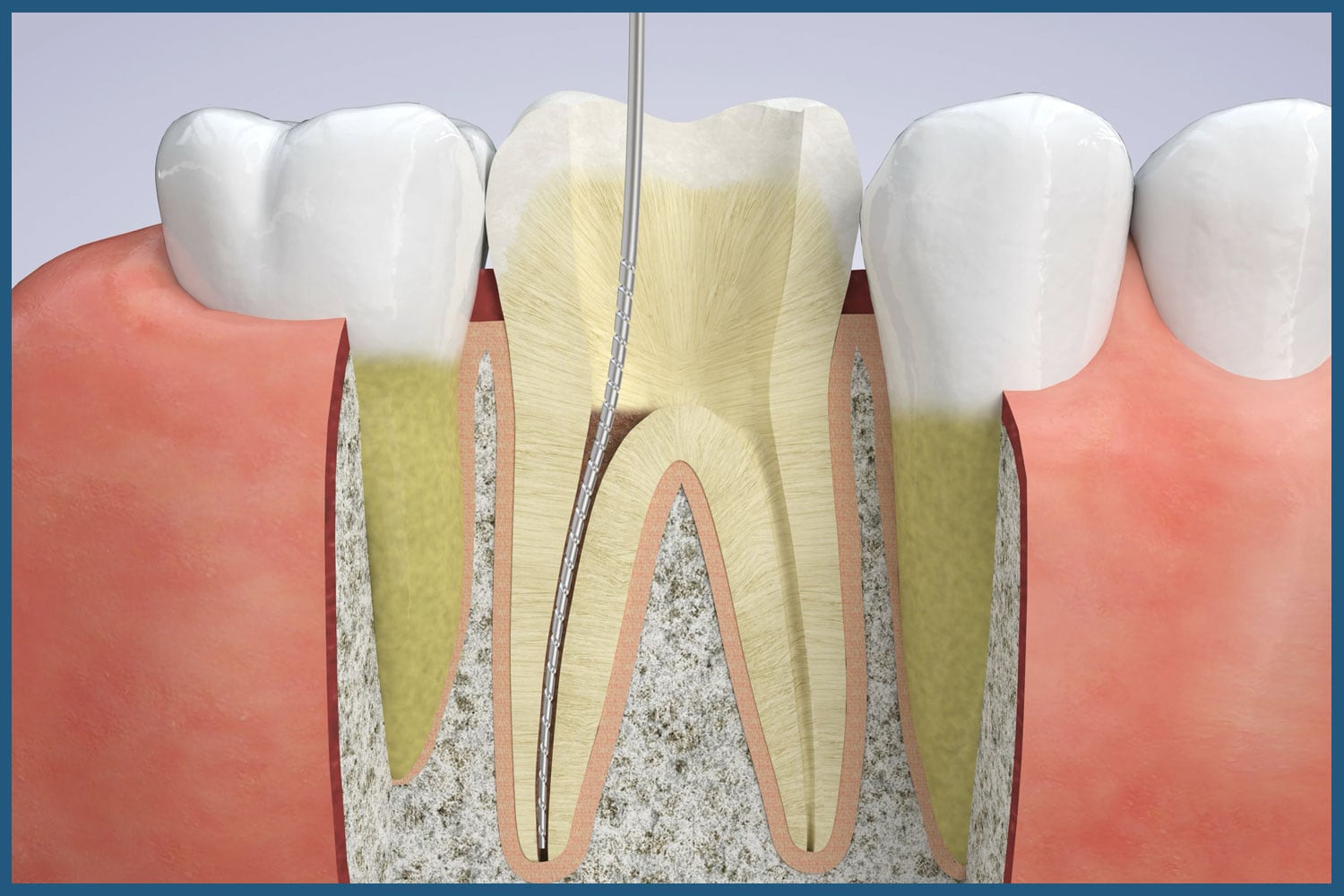 Stages of root canal therapy at Way Dental