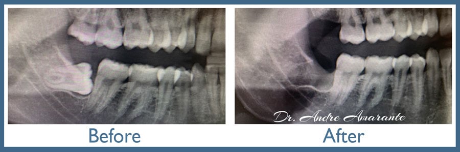 wisdom teeth before and after