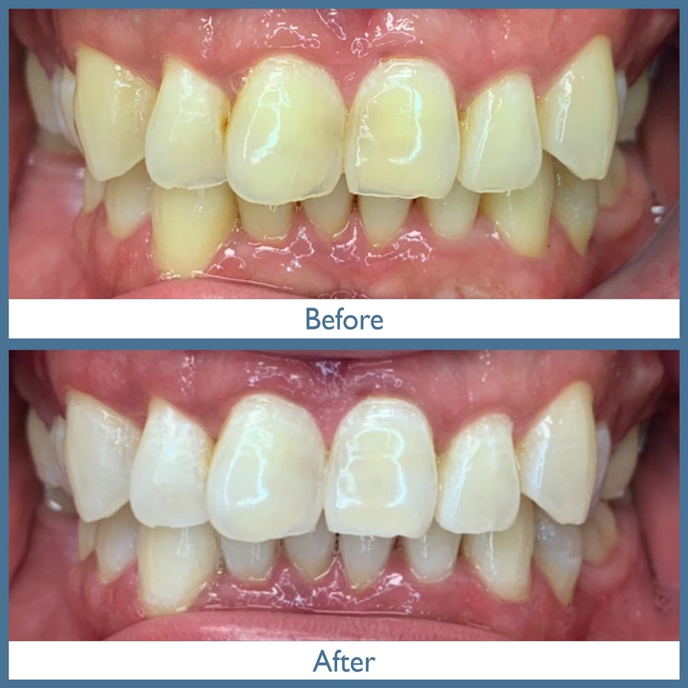 Way Dental Before and After in Evanston, IL