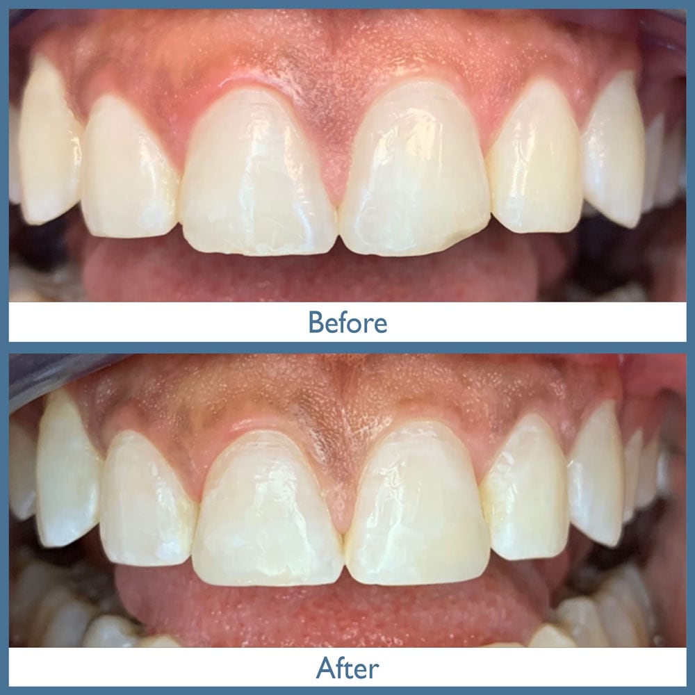 Way Dental Before and After in Evanston, IL