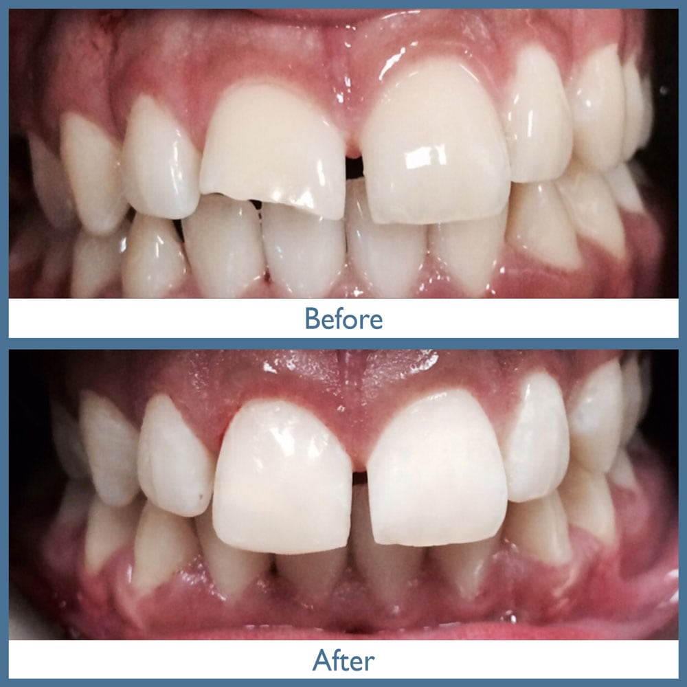 Way Dental Before and After in Evanston, IL