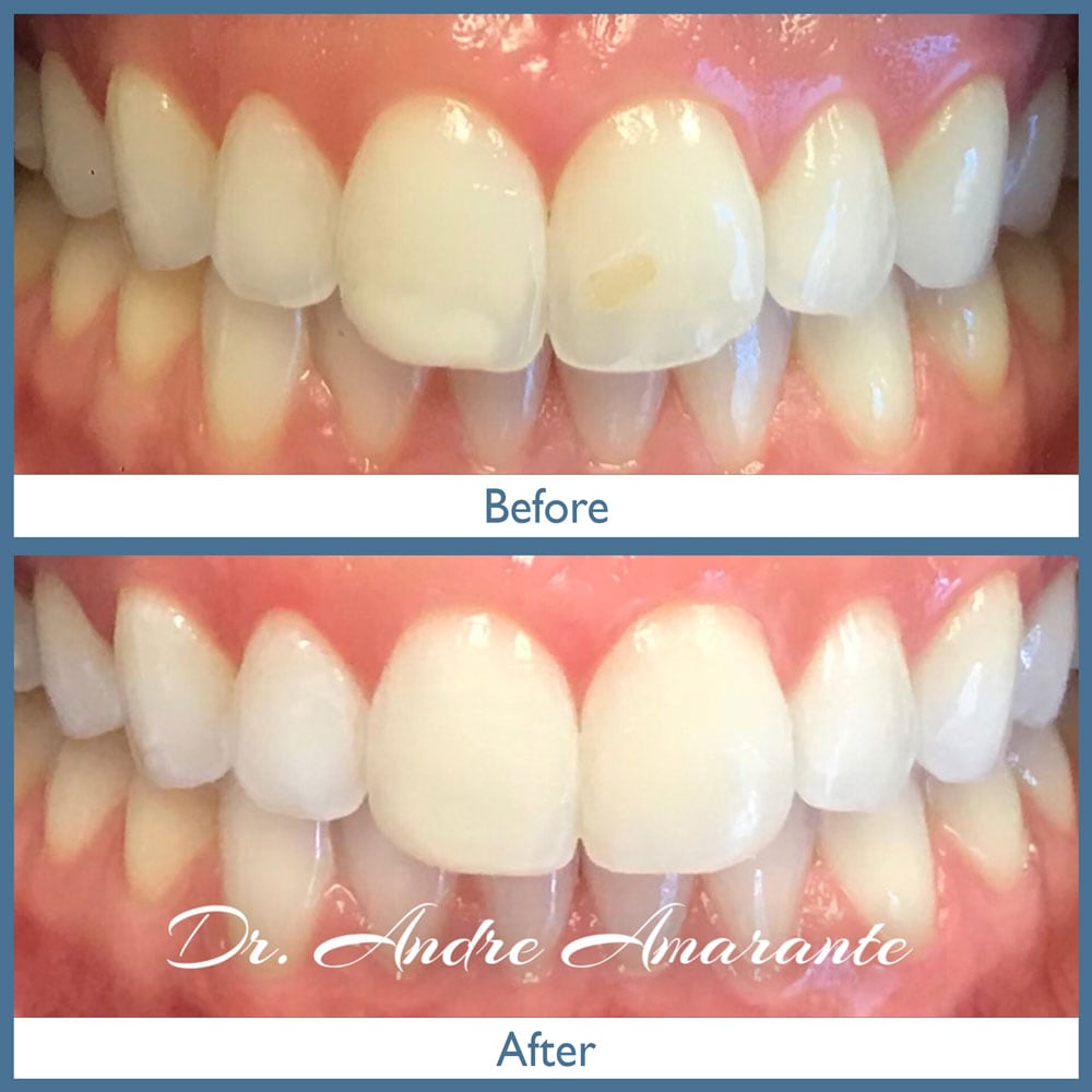 Way Dental Before and After in Evanston, IL