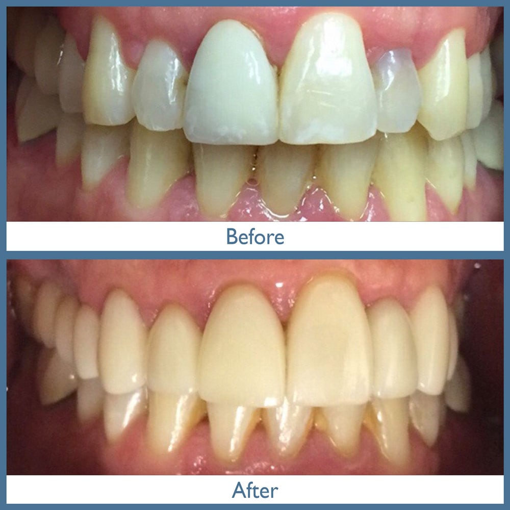 Way Dental Before and After in Evanston, IL