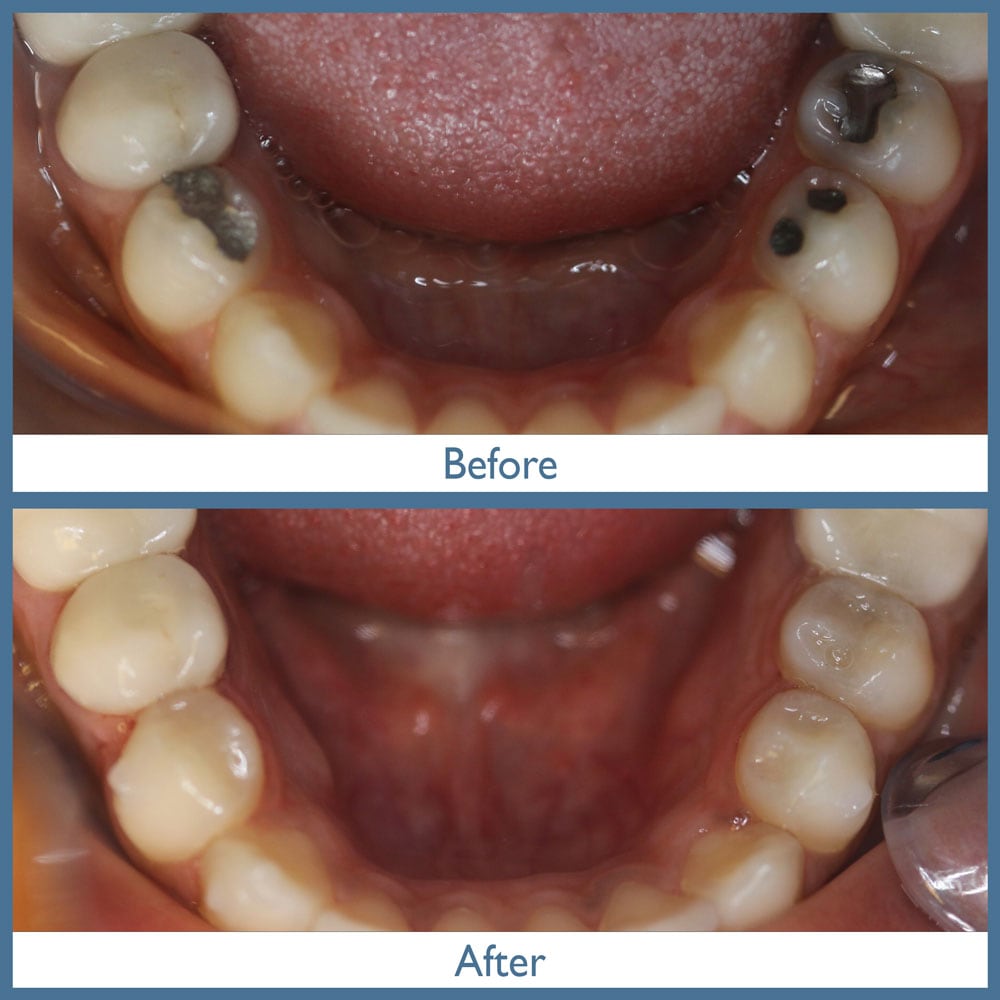 Way Dental Before and After in Evanston, IL