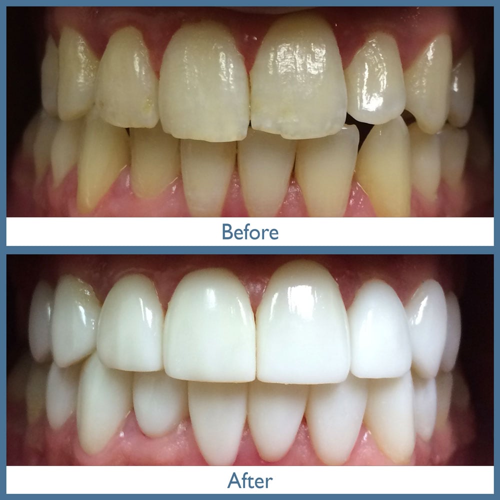 Way Dental Before and After in Evanston, IL