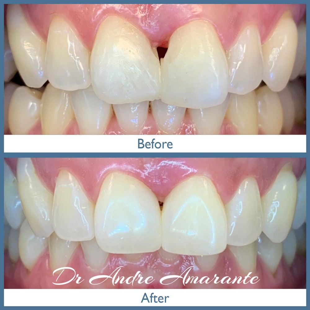 Way Dental Before and After in Evanston, IL