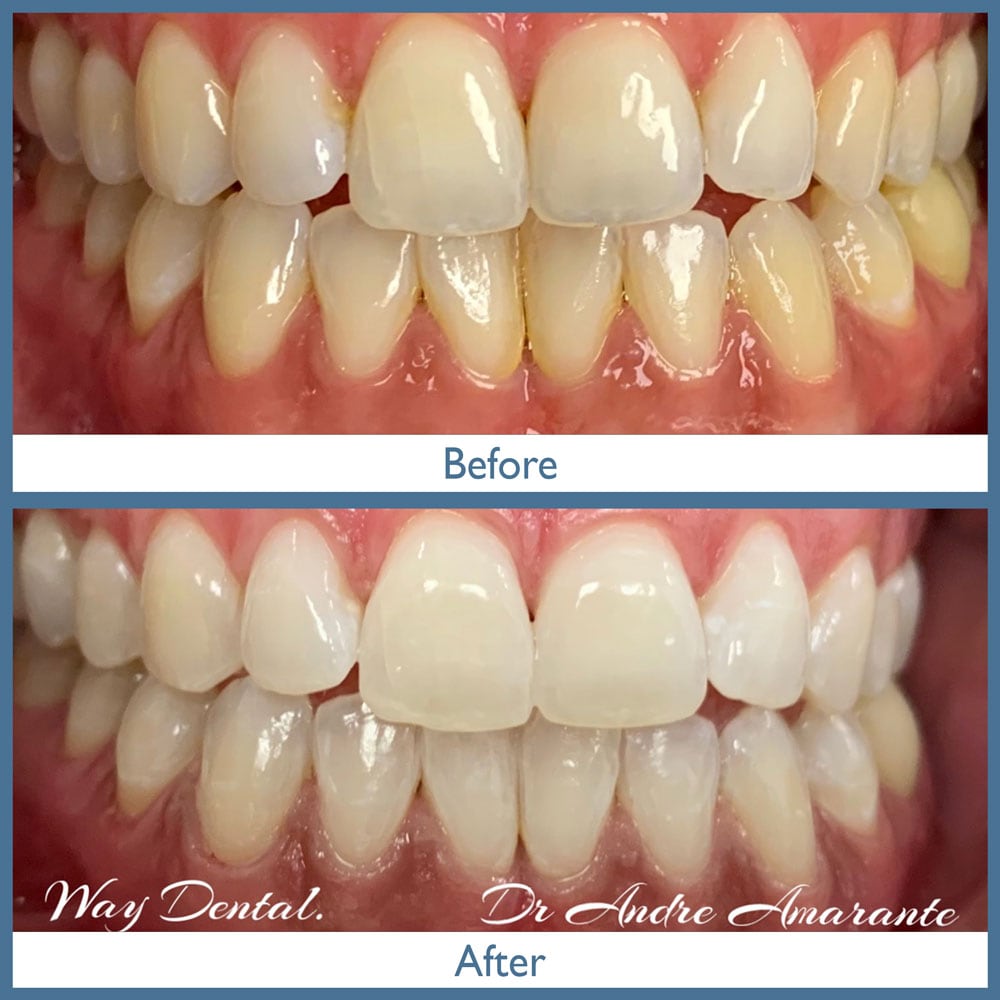 Way Dental Before and After in Evanston, IL