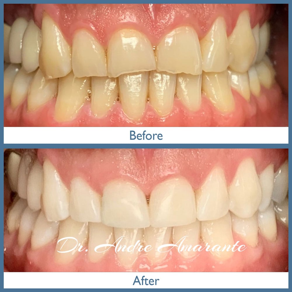 Way Dental Before and After in Evanston, IL