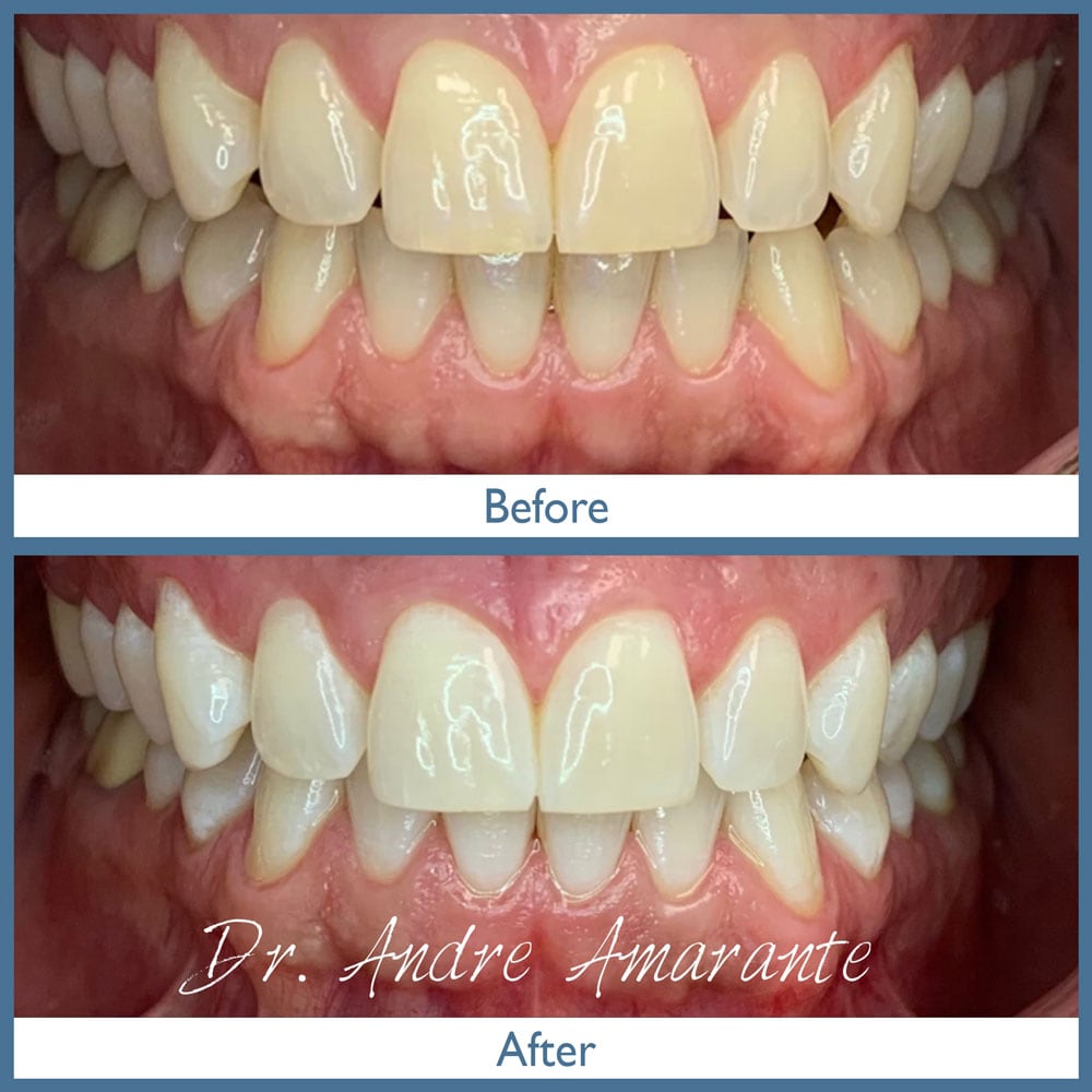 Way Dental Before and After in Evanston, IL