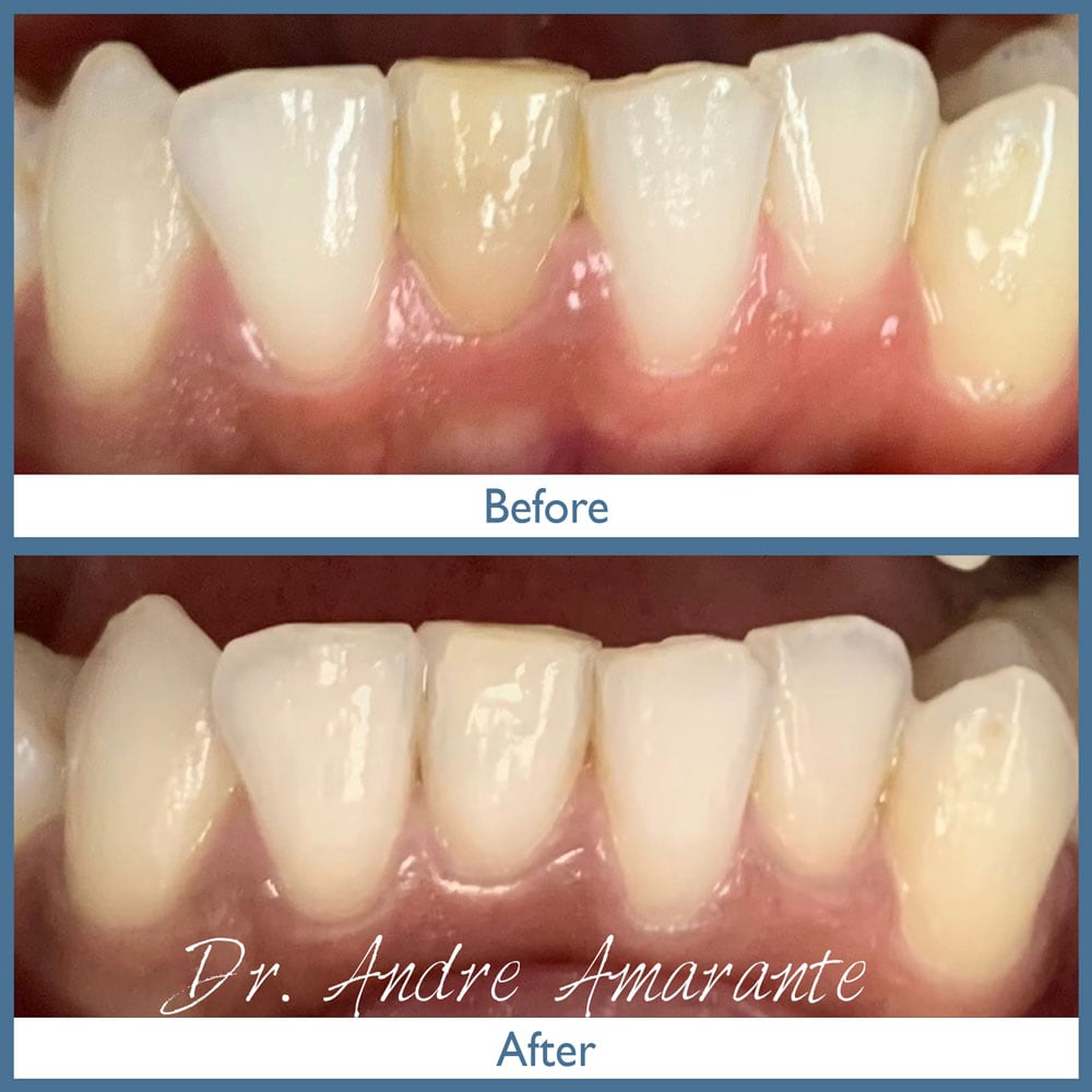 Way Dental Before and After in Evanston, IL