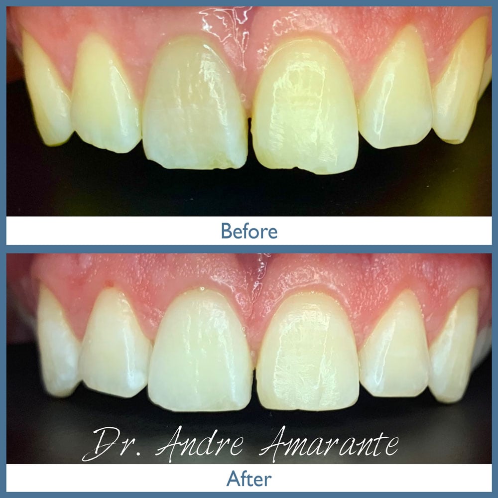 Way Dental Before and After in Evanston, IL