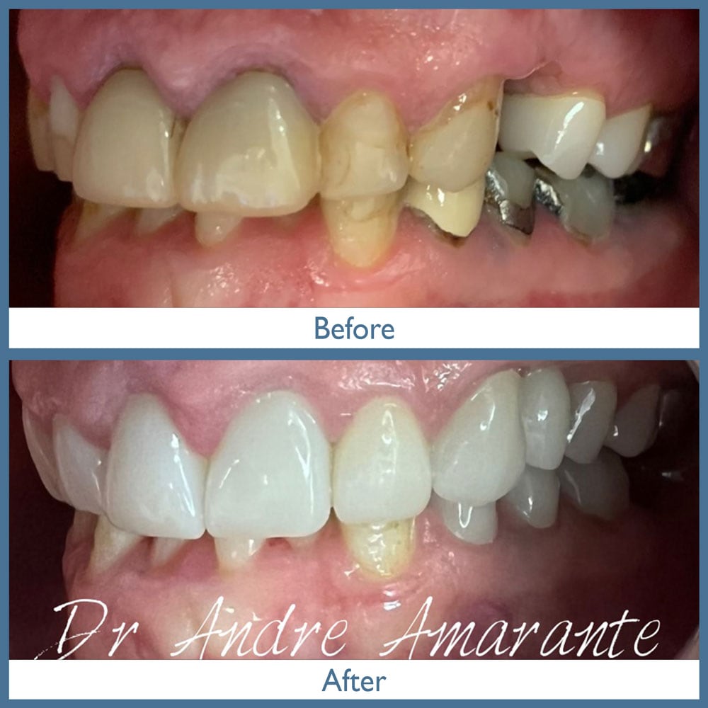 Way Dental Before and After in Evanston, IL