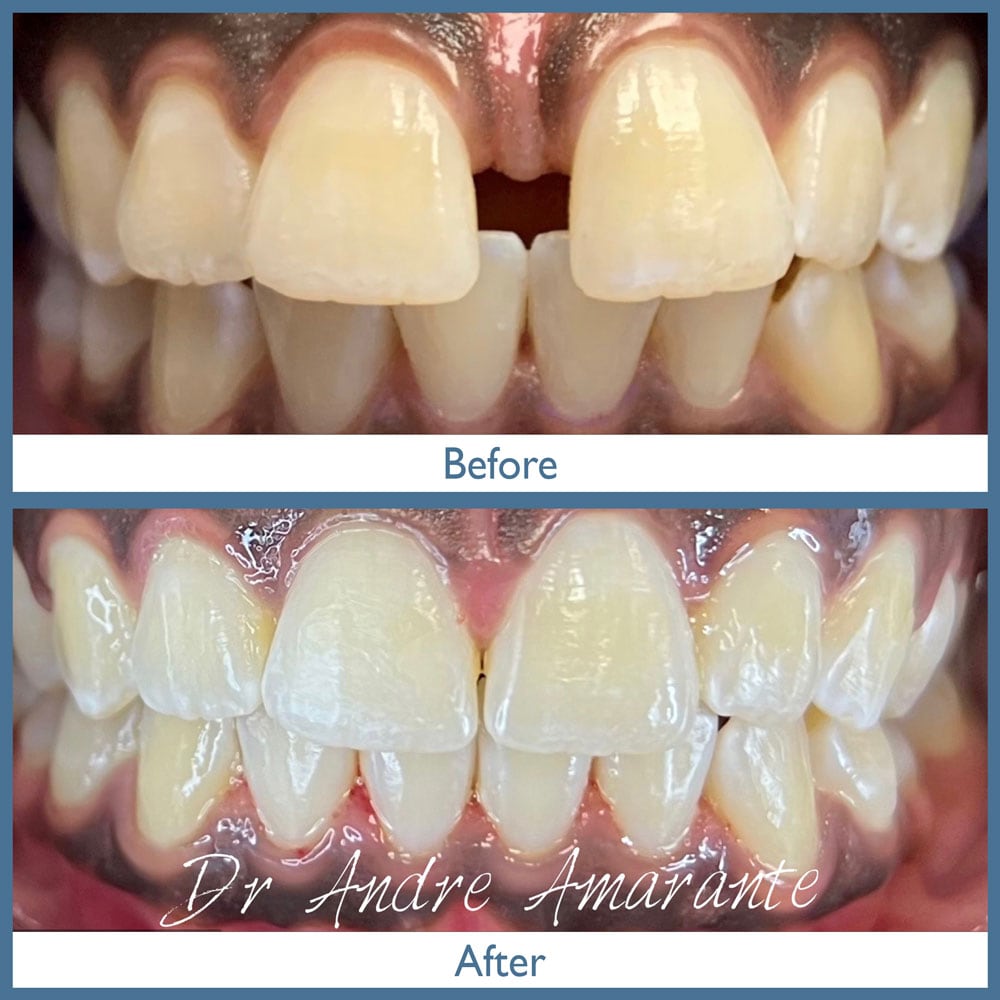 Way Dental Before and After in Evanston, IL