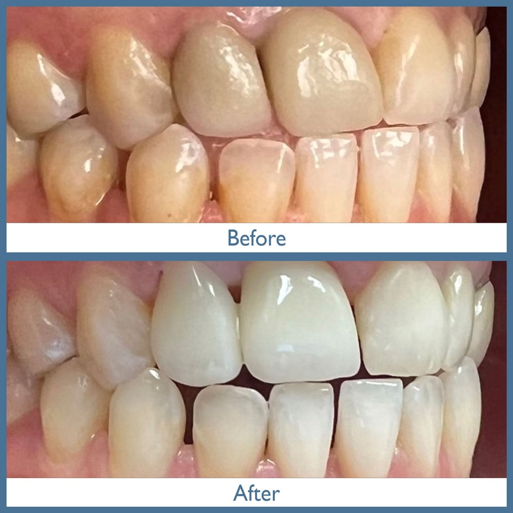 Way Dental Before and After in Evanston, IL