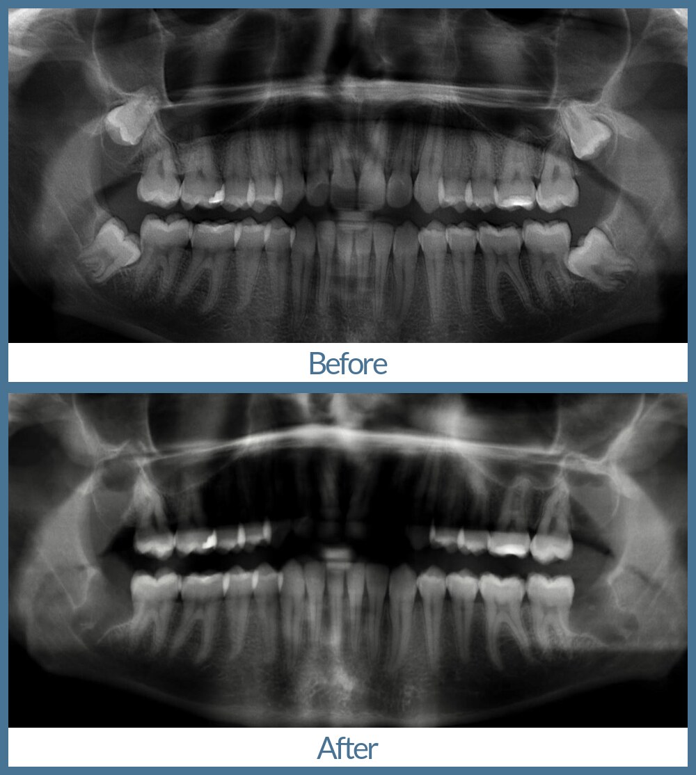 Before and after wisdom tooth extraction at Way Dental in Evanston, IL