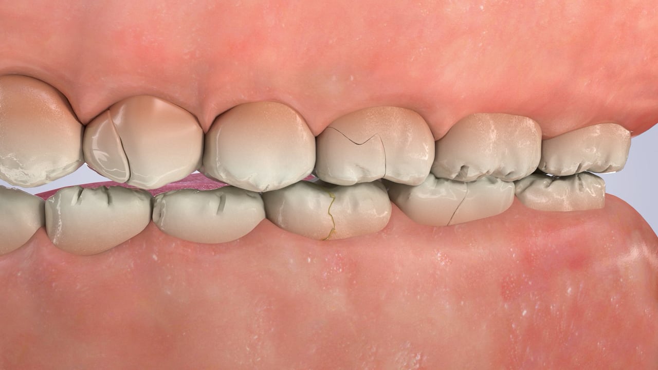 Poster image for the Teeth Grinding (Bruxism) patient-education video