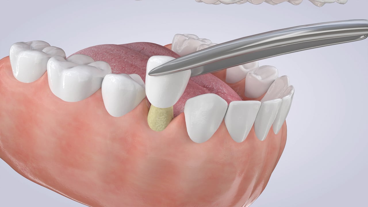 Poster image for the Dental Crowns patient-education video