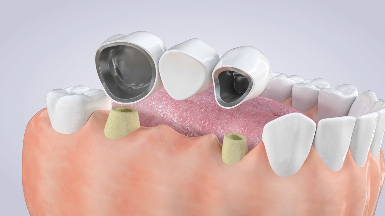 Poster image for the Dental Bridges patient-education video