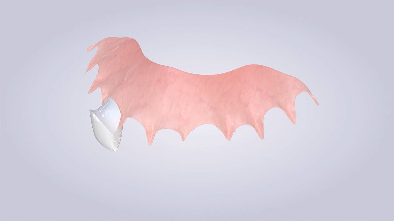 Poster image for the Dental Flipper patient-education video