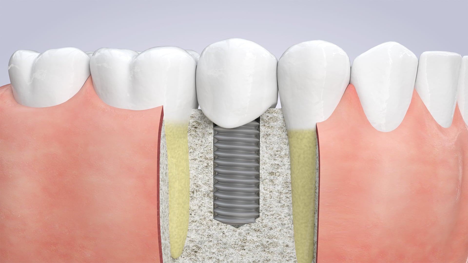 Poster image for the Dental Implants patient-education video