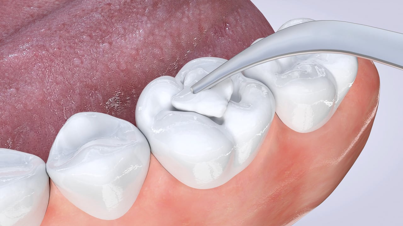 Poster image for the Dental Fillings patient-education video