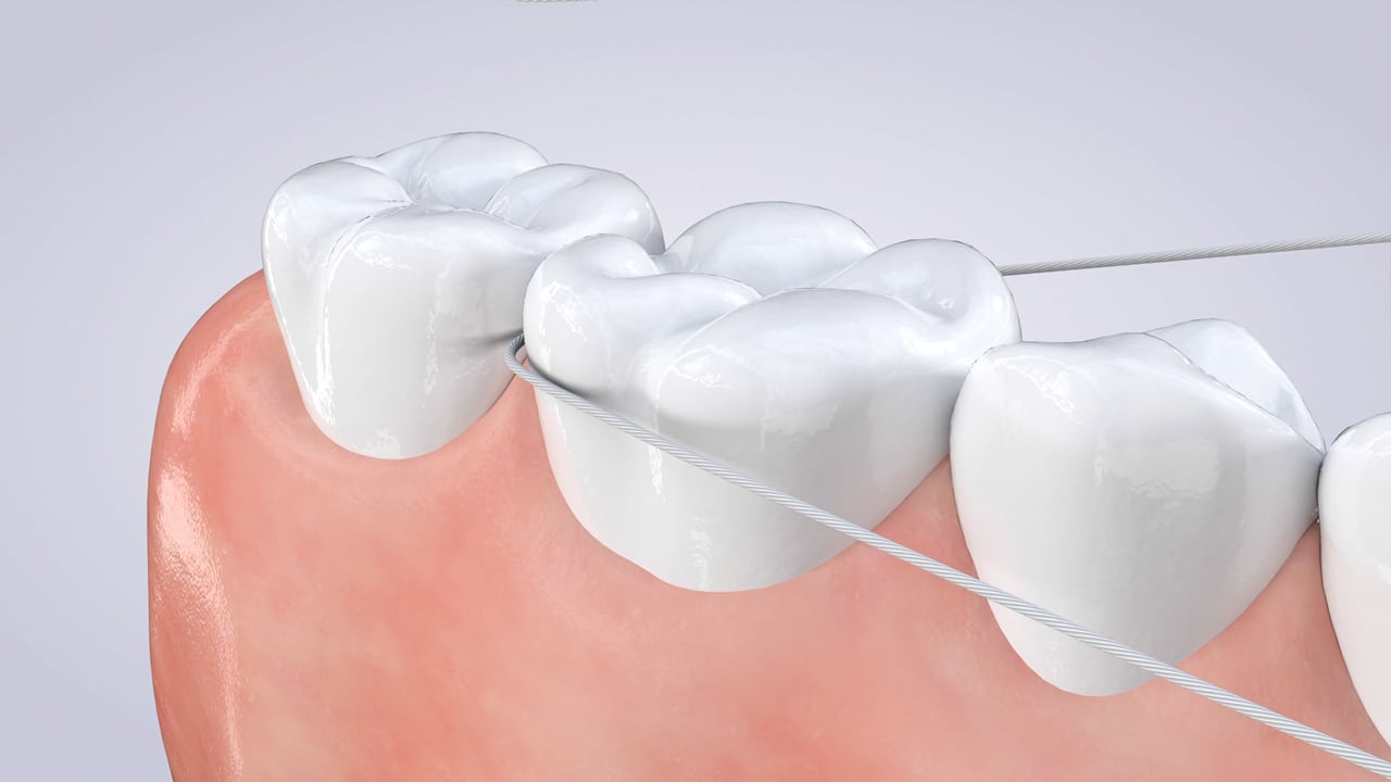 Poster image for the Proper Flossing Technique patient-education video