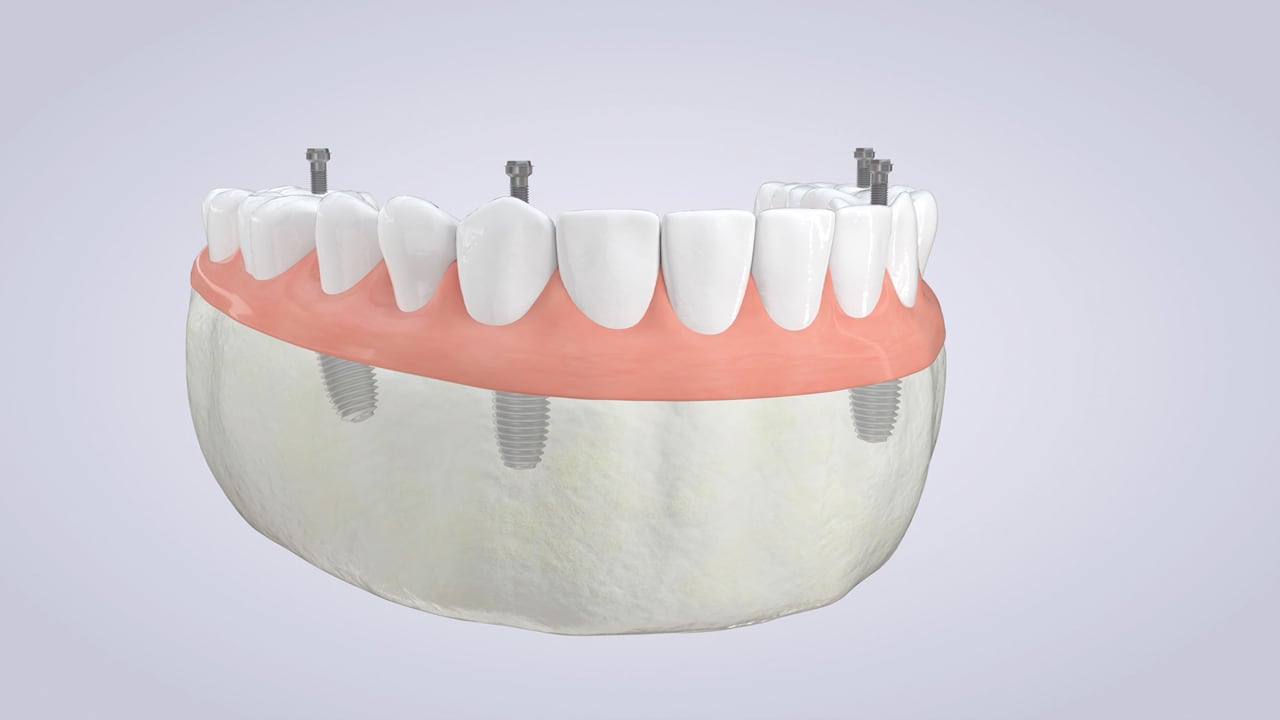 Poster image for the Full Mouth Restoration patient-education video