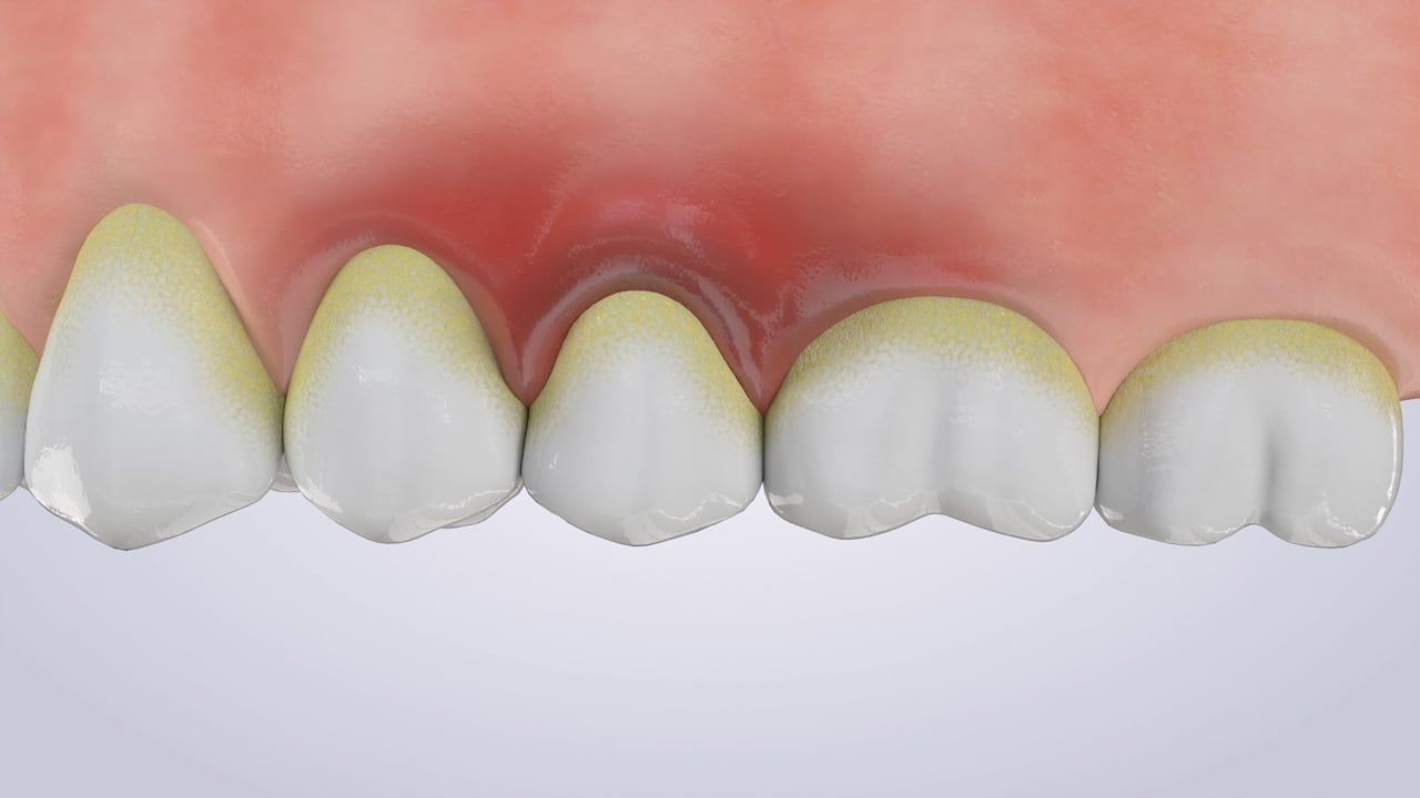 Poster image for the Gum Disease patient-education video