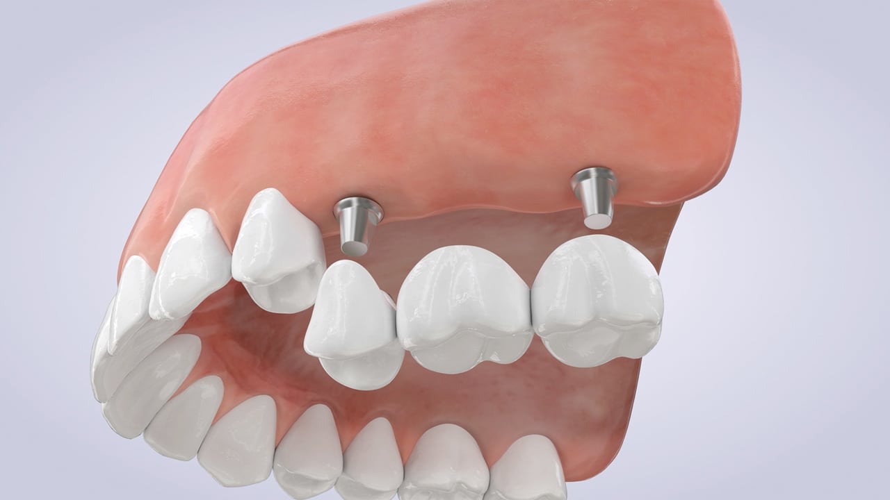 Poster image for the Implant-Supported Bridge patient-education video