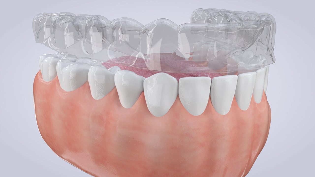 Poster image for the Invisible Aligners patient-education video