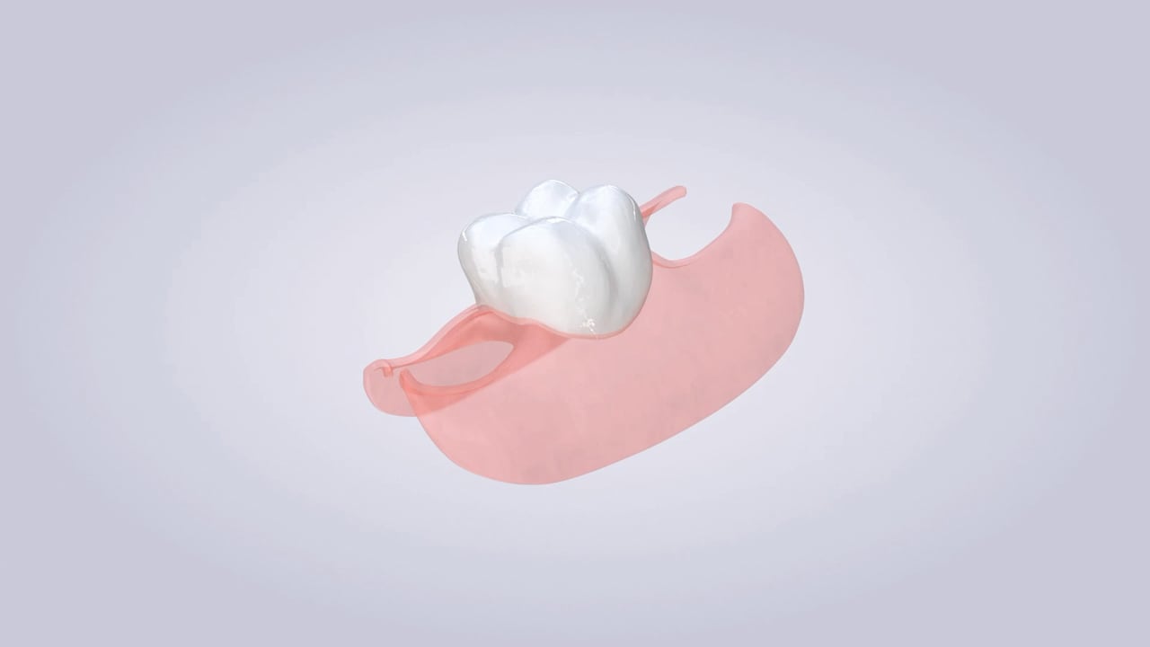 Poster image for the Nesbit Partial Denture patient-education video