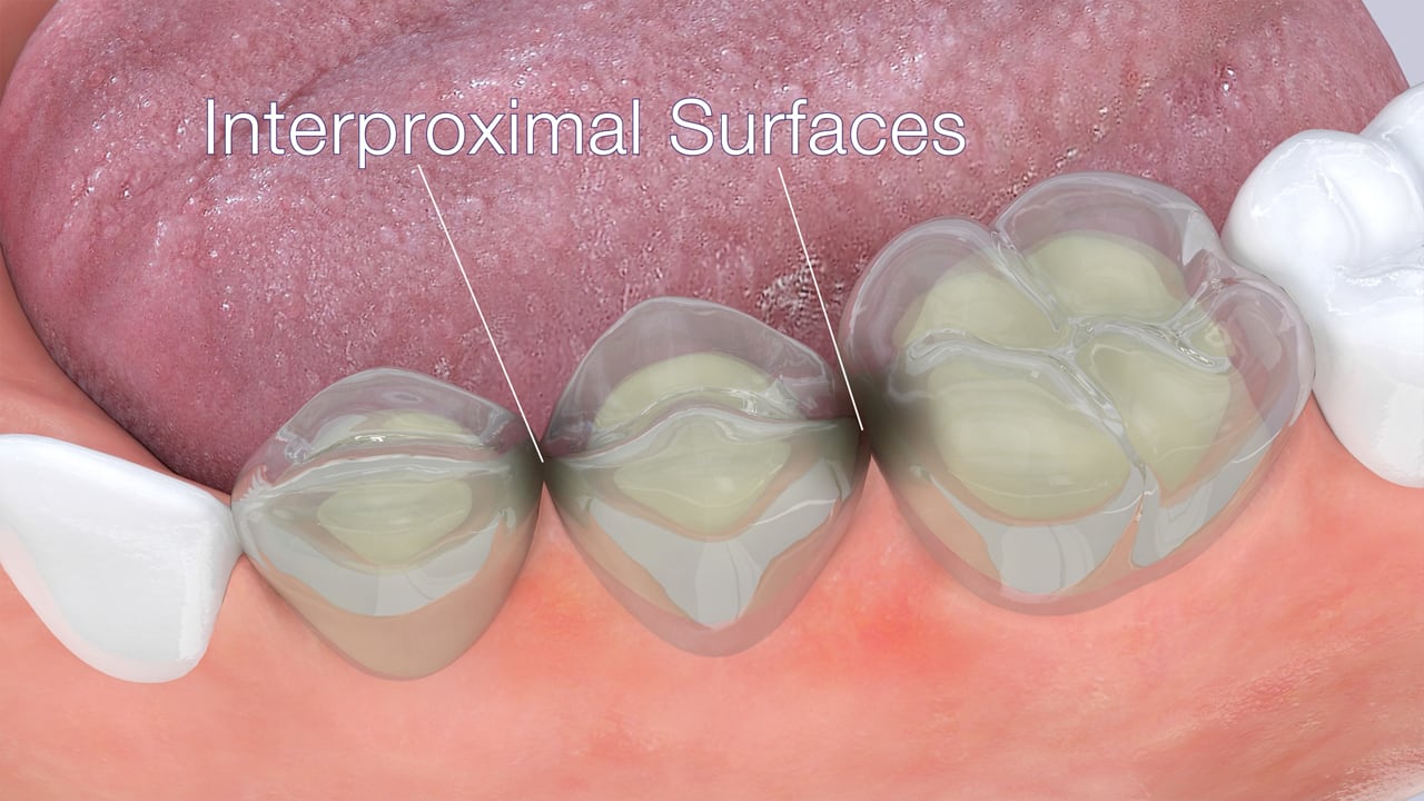 Poster image for the Oral Hygiene patient-education video