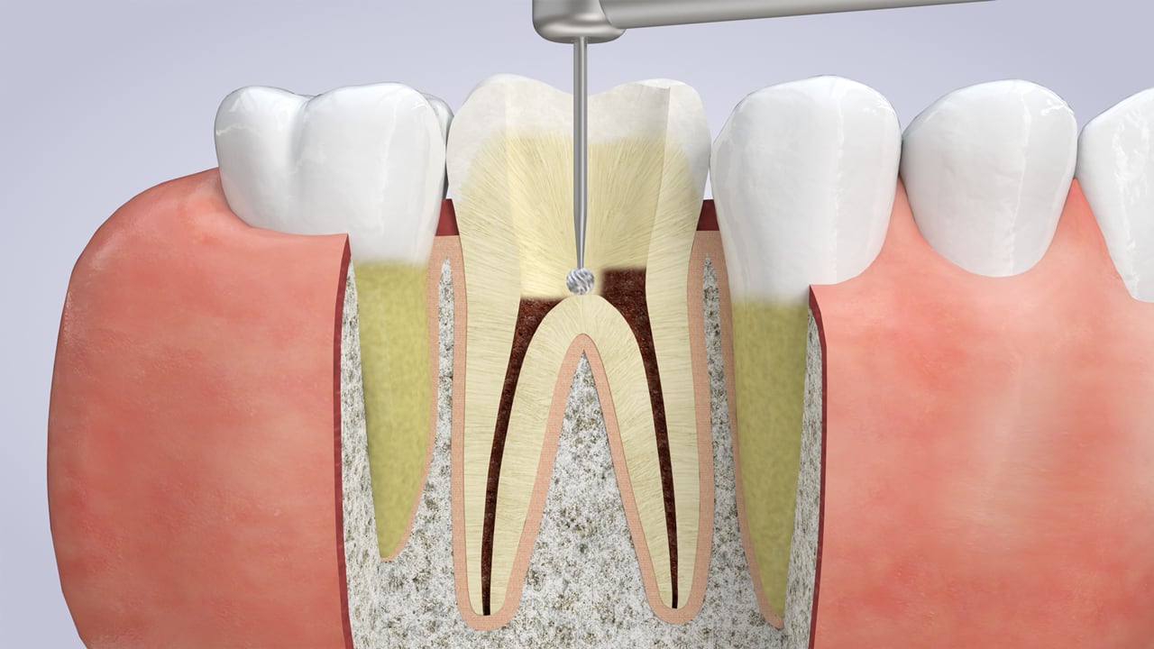 Poster image for the Root Canal Therapy patient-education video