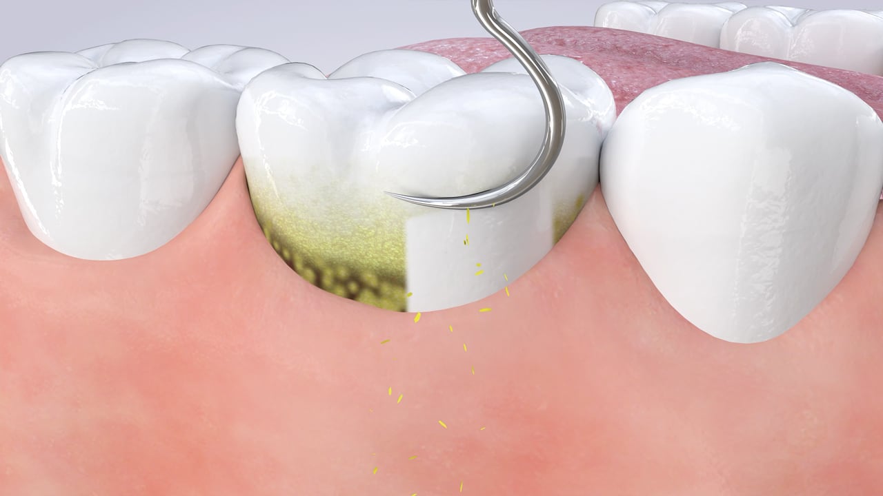 Poster image for the Scaling & Root Planing patient-education video