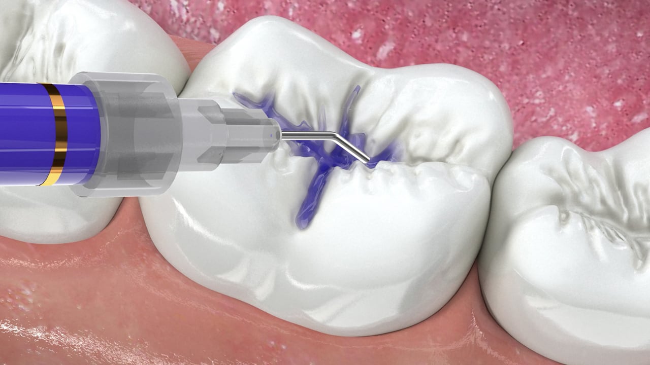 Poster image for the Dental Sealants patient-education video