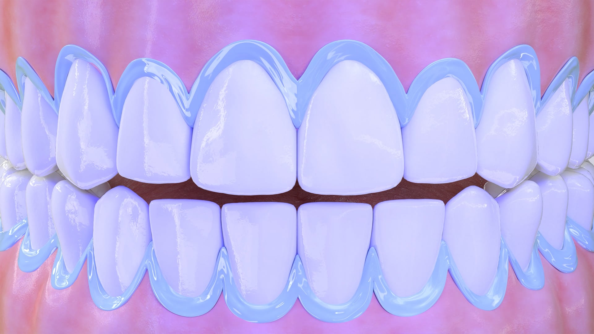 Poster image for the In-Office Teeth Whitening patient-education video