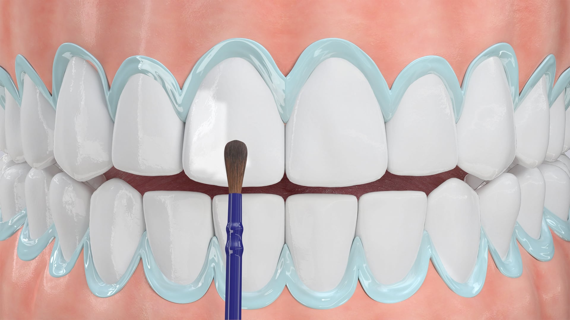 Poster image for the Teeth Whitening patient-education video