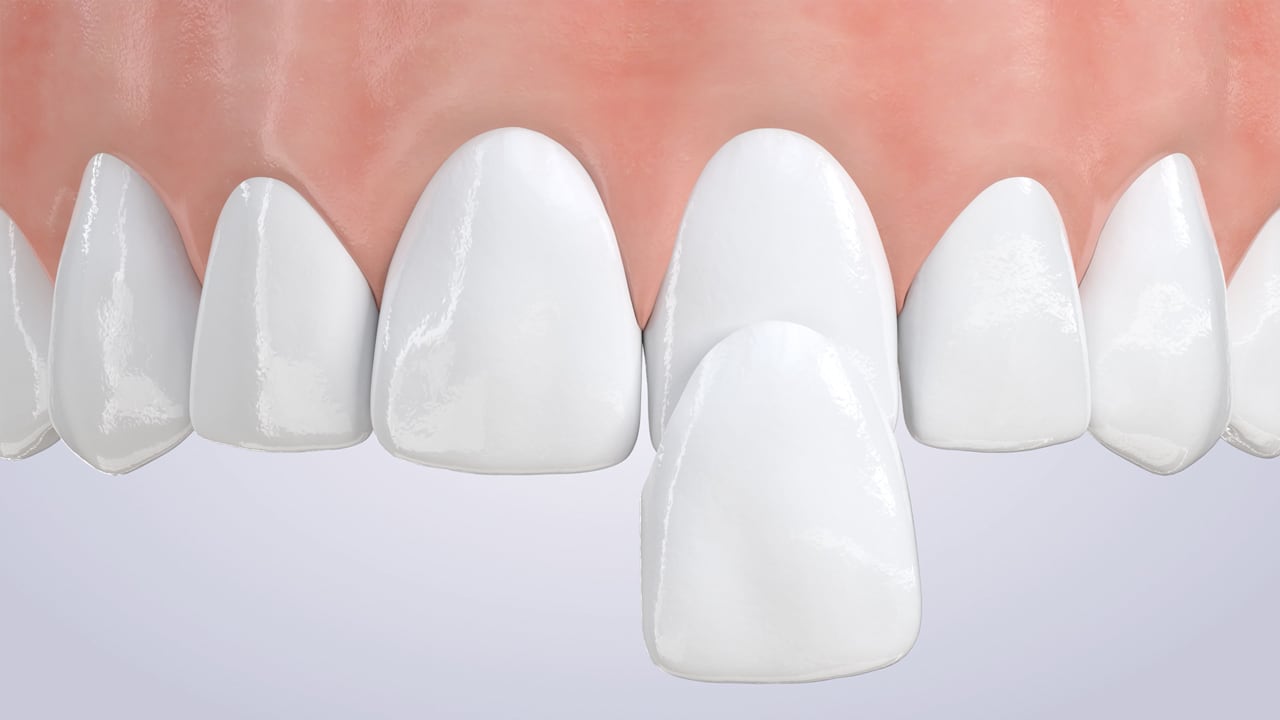 Poster image for the Porcelain Veneers patient-education video