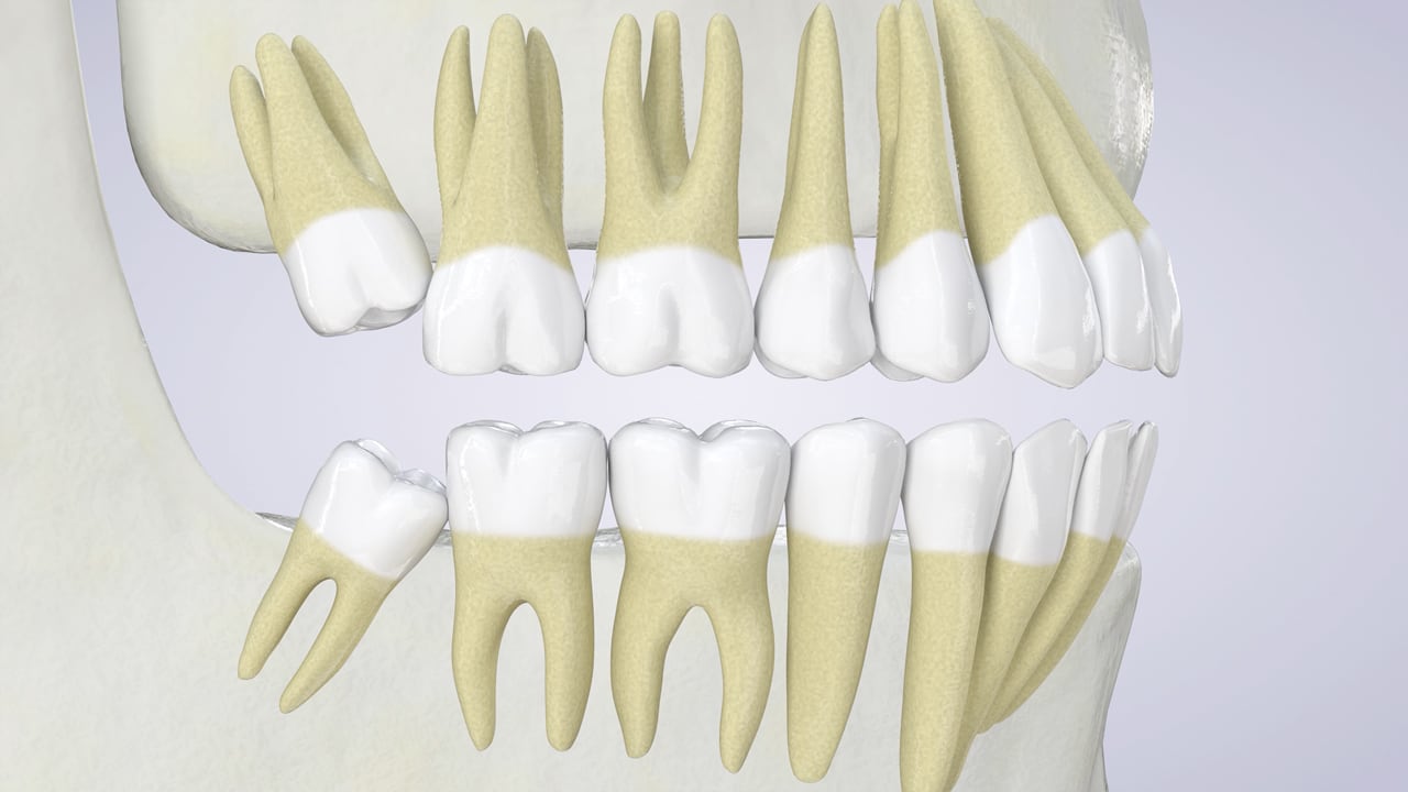 Poster image for the Wisdom Teeth patient-education video