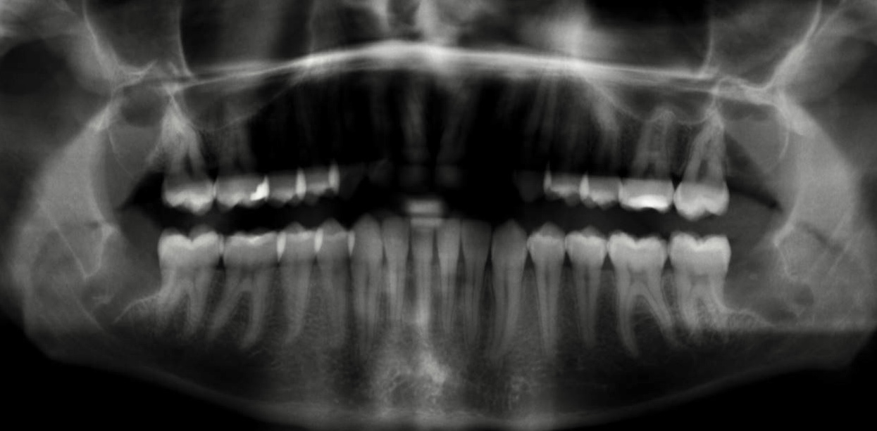 Panoramic dental X-ray taken after treatment, showing healed extraction sites where the four wisdom teeth used to be