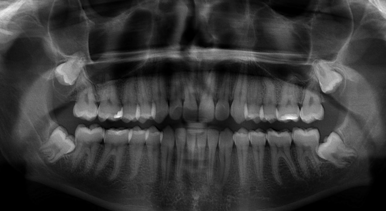 Panoramic dental X-ray taken before treatment, showing four impacted wisdom teeth angled toward the molars next to them
